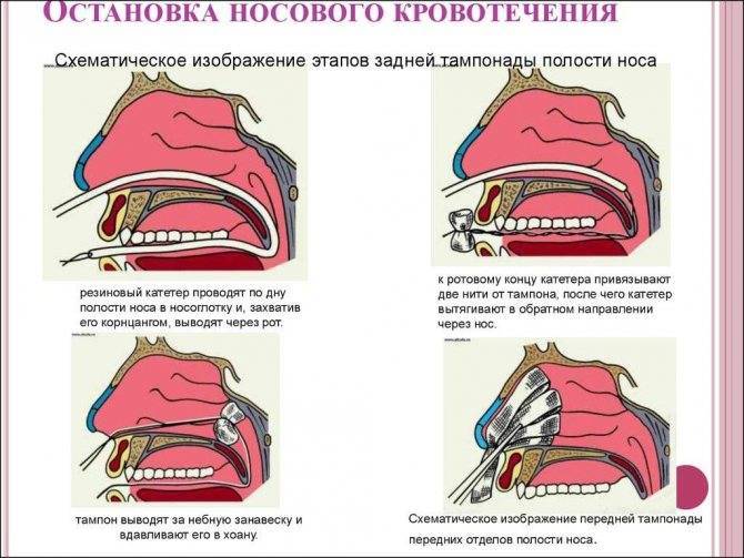 Носовое кровотечение карта вызова скорой медицинской помощи локальный статус