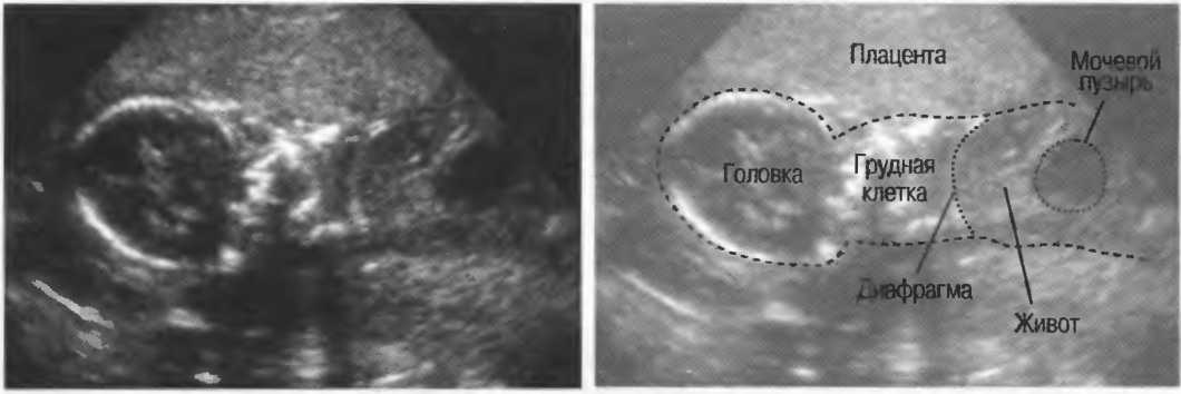 Тонус передней стенки матки. Гипертонус матки при беременности 2 триместр УЗИ. Тонус матки при беременности 1 триместр УЗИ. УЗИ картина предлежания плаценты.