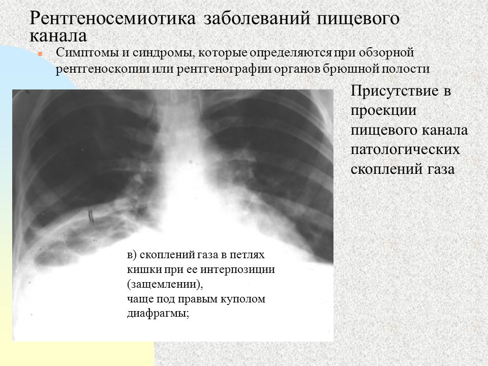 Заболевания диафрагмы презентация