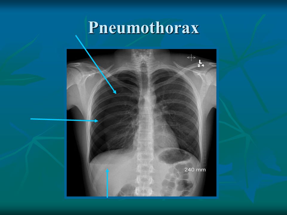 Спонтанный пневмоторакс картинки