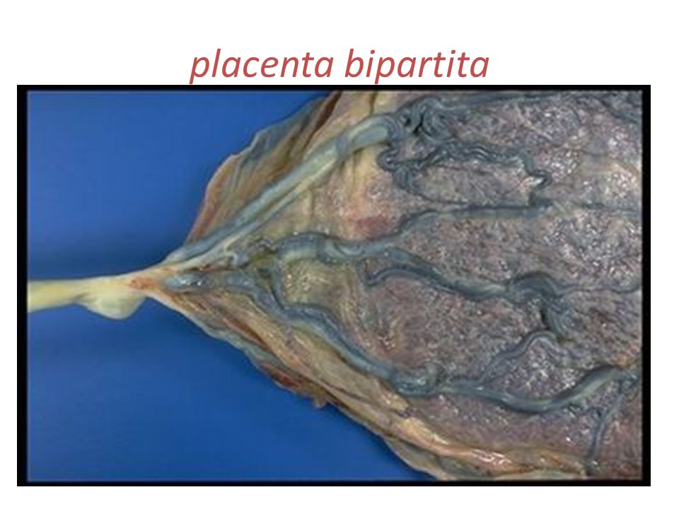 placenta bipartita