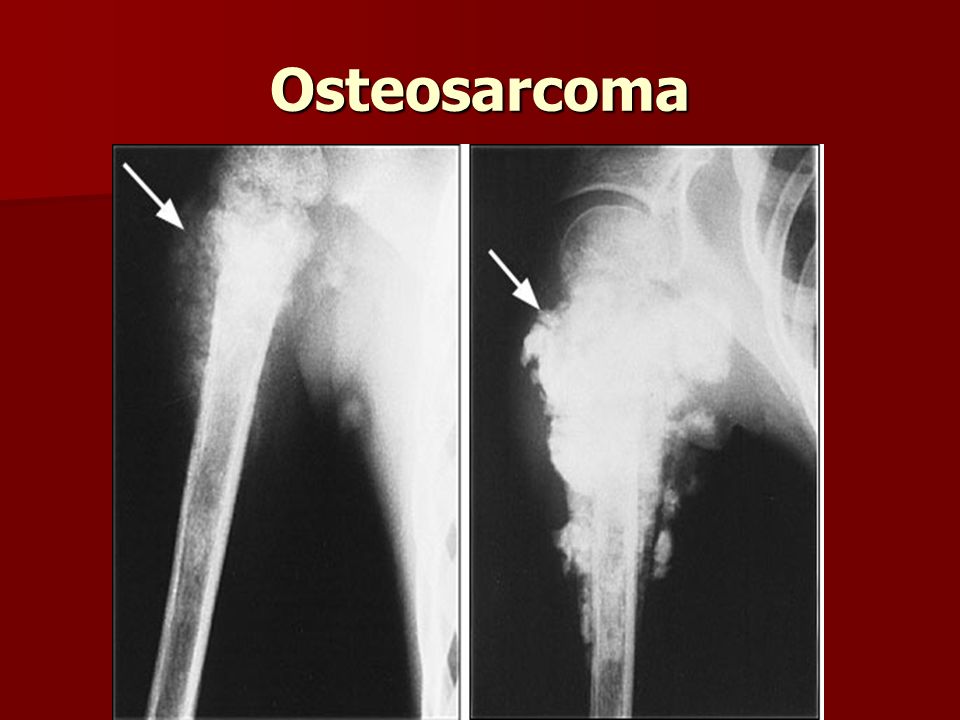 Патологическим костеобразованием напоминающим картину саркомы осложняется