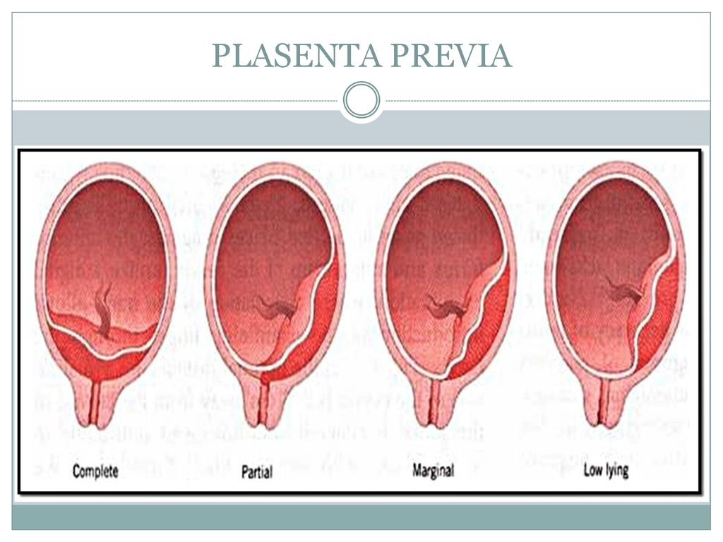Зев закрыт при беременности. Плацента перекрывает внутренний зев. Краевое предлежание плаценты перекрытие зев. Предлежание плаценты внутренний зев закрыт. Хорион перекрывает внутренний зев.