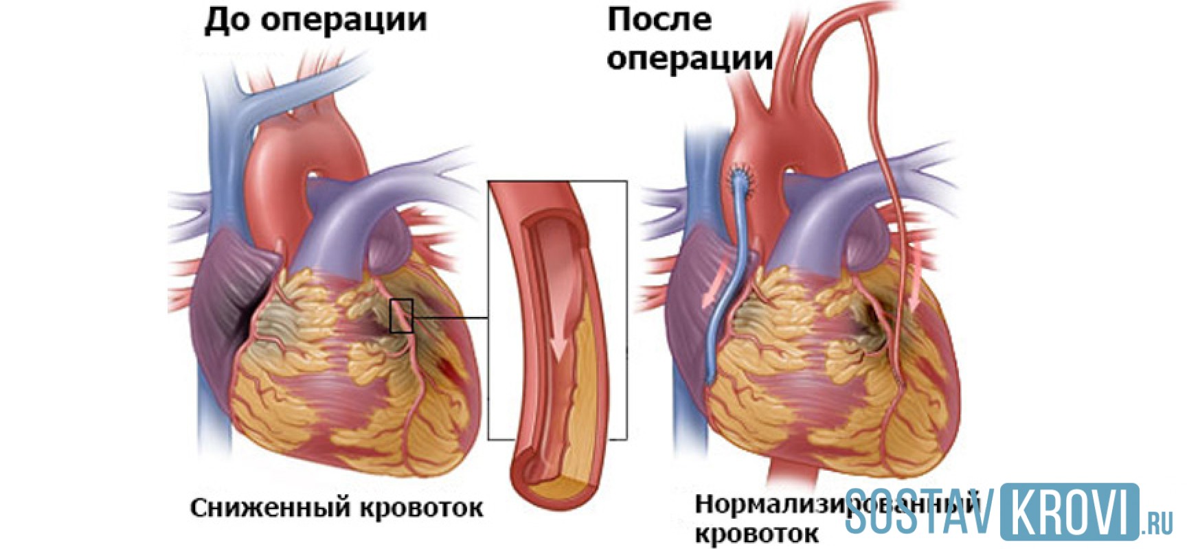Поставили шунты. Шунтирование коронарных артерий. Аортокоронарное шунтирование хирургия. Маммарно коронарное шунтирование. Коронарное шунтирование сосудов сердца.