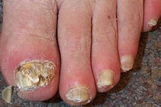 фото Поражение ногтей при ВИЧ-инфекции