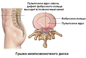 Межпозвонковая грыжа	