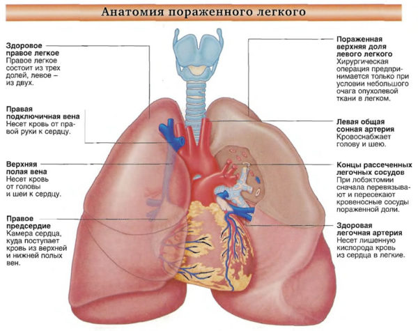 Анатомия пораженного легкого