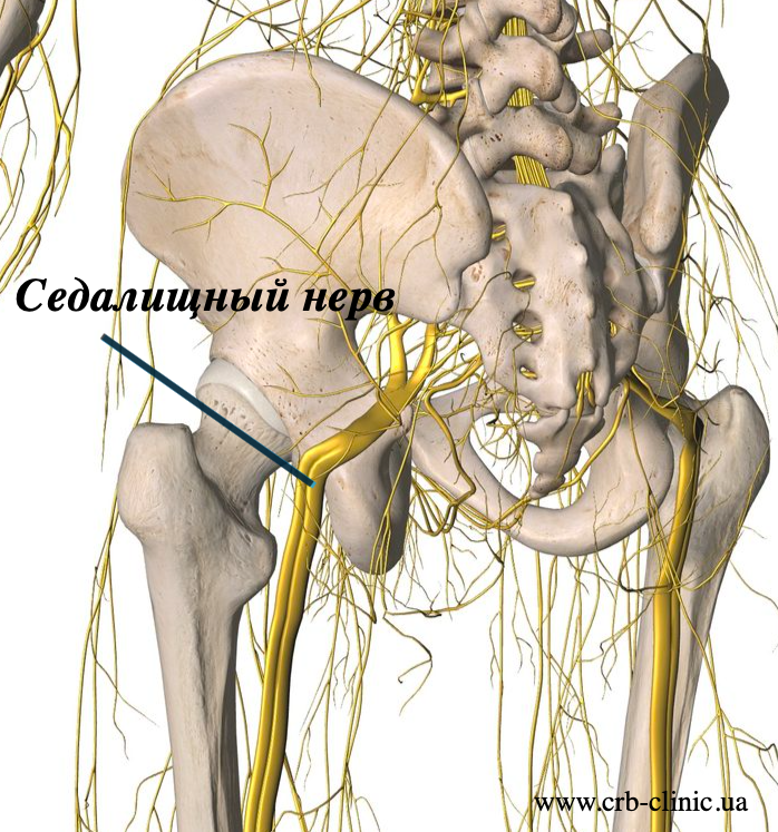 Воспаление седалищного нерва признаки симптомы
