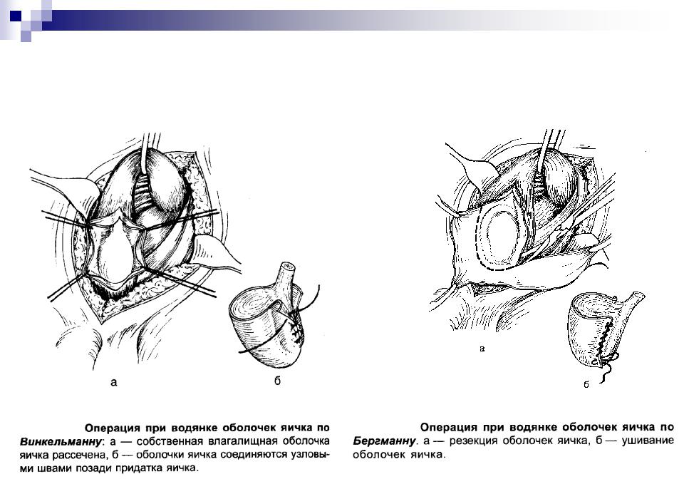 Гидроцеле яичка. Операция Винкельмана Бергмана. Операция при гидроцеле Бергмана. Операции Винкельмана и Бергмана при водянке яичка. Операция Росса при водянке яичка у ребёнка.
