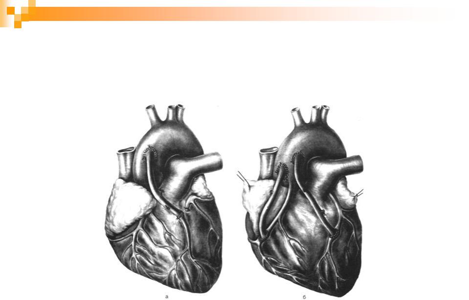 Аортокоронарное шунтирование схема операции