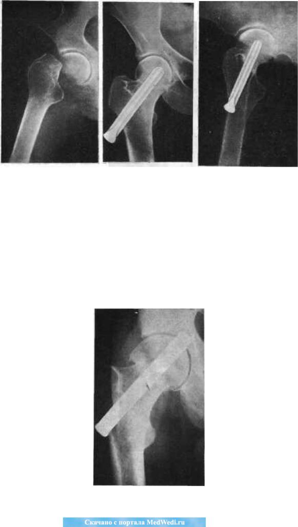Перелом шейки бедра операция. Варусный перелом шейки бедра. Аддукционный перелом шейки бедра. Вколоченный перелом шейки бедра рентген. Базисцервикальный перелом бедренной кости.
