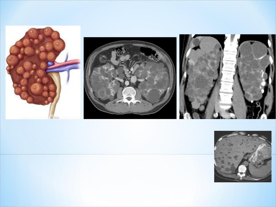 Поликистоз почек на узи