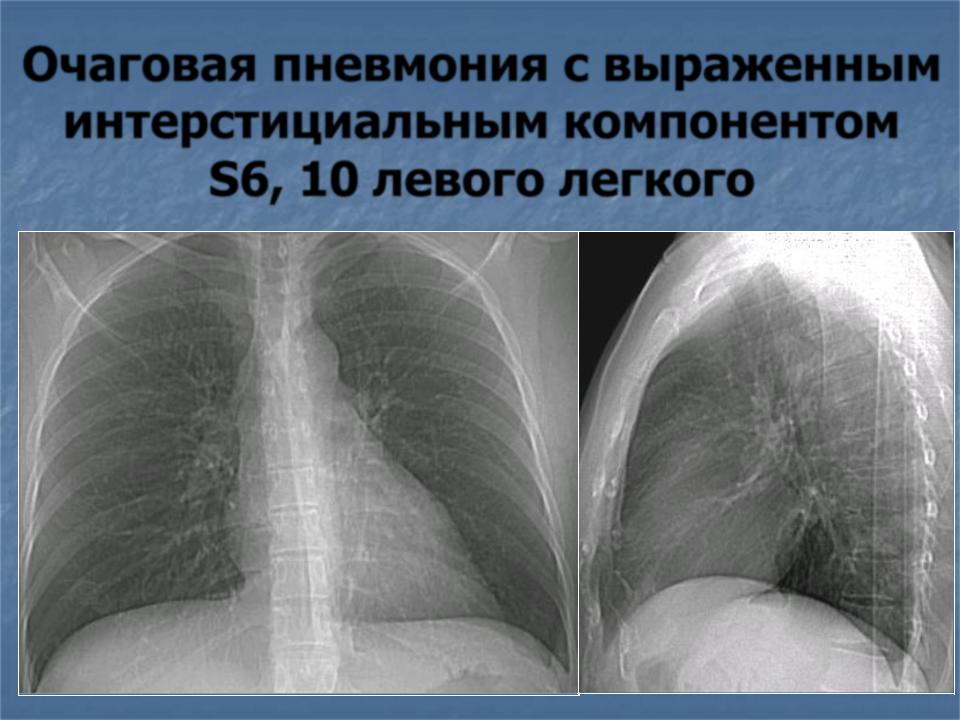 Что означает изменения в легких. Правосторонняя очаговая пневмония рентген. Очаговая пневмония легкого рентген. Крупноочаговая пневмония рентген. Очаговая пневмония в левом легком рентген.