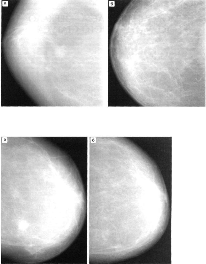 Фиброзная инволюция молочных желез маммография. Склерозирующий аденоз маммография. Микрогландулярный аденоз.