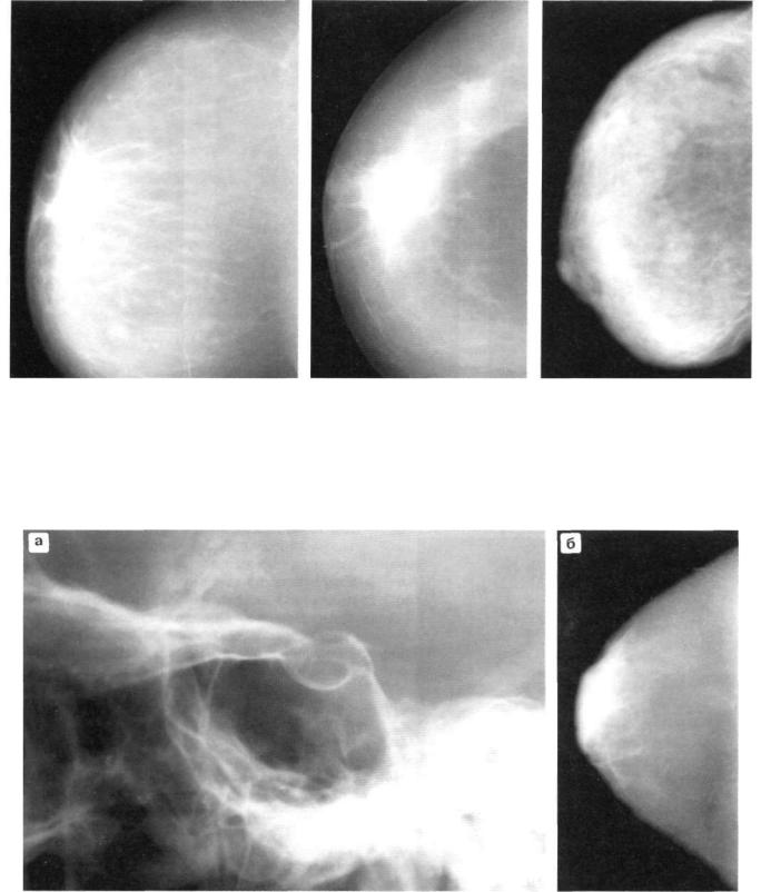 Картина инволютивных изменений молочных желез