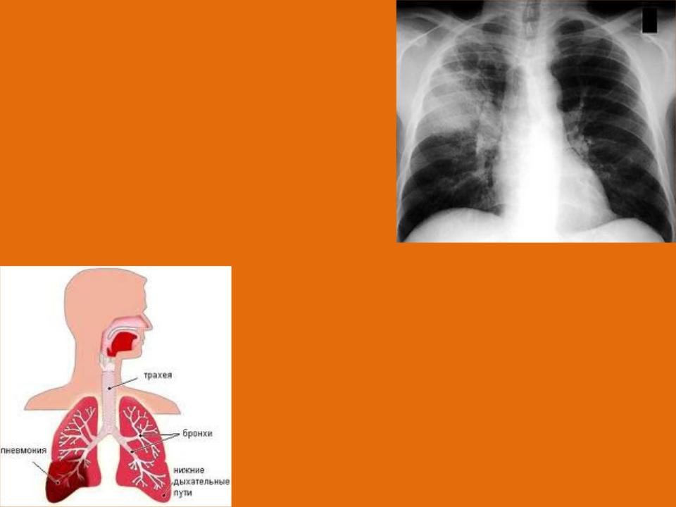 Отличие пневмонии. Бронхит и пневмония на рентгене. Пневмония нижних дыхательных путей. Бронхит и легкие пневмонию.