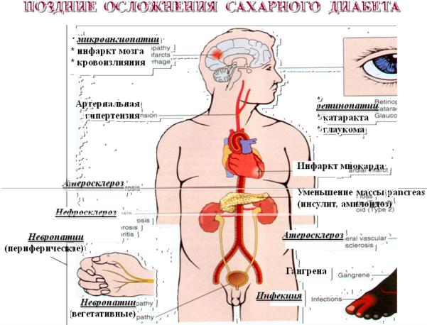 Осложнения сахарного диабета презентация