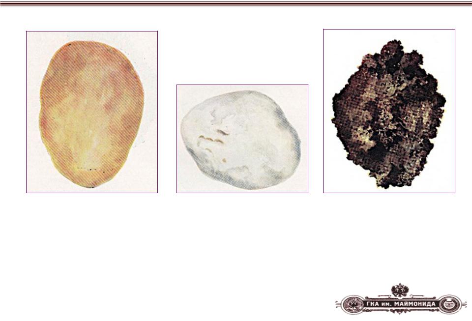 Виды почечных камней фото и названия и описание внешности