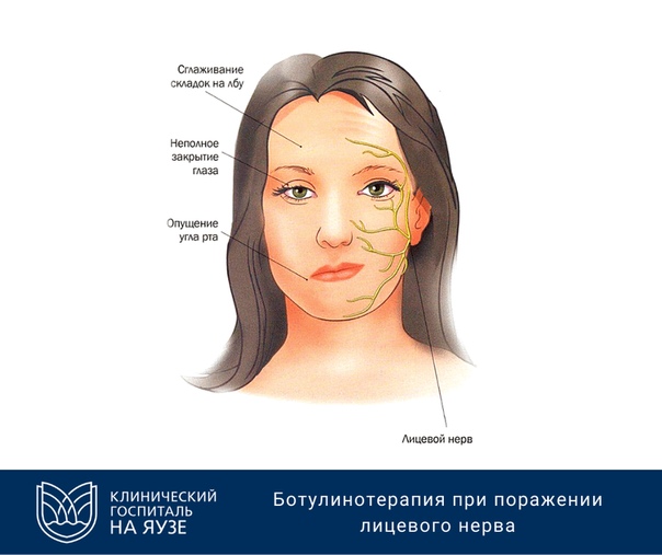 Неврит лицевого нерва карта вызова скорой