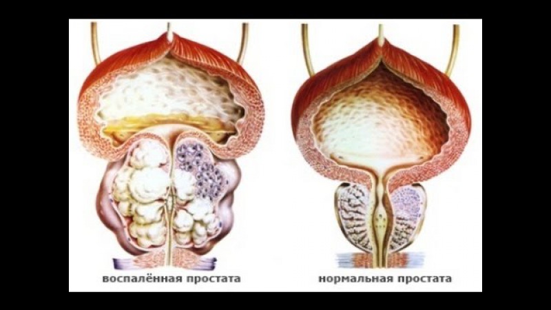 Толстая простата