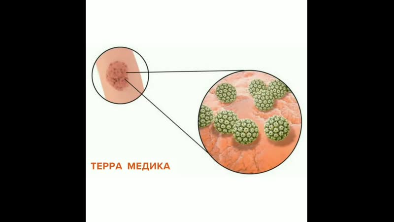 Человека папилломы человека рисунок