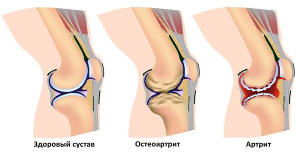 Боль может быть вызвана патологическими изменениями суставов