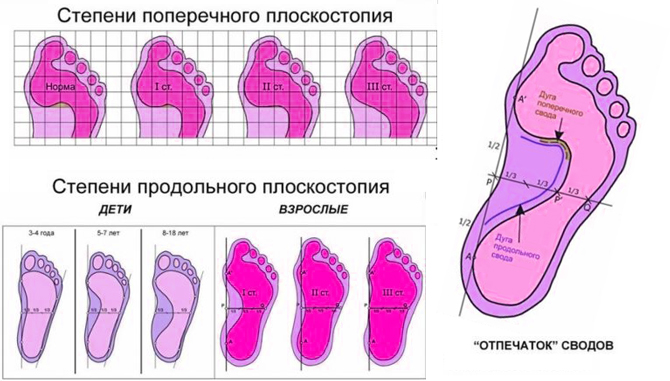 Стадии плоскостопия у взрослых с фото