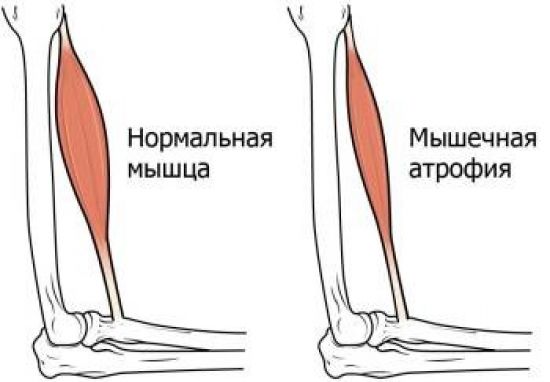 Мышечная атрофия