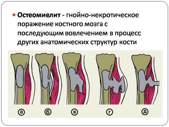 Остеомиелит