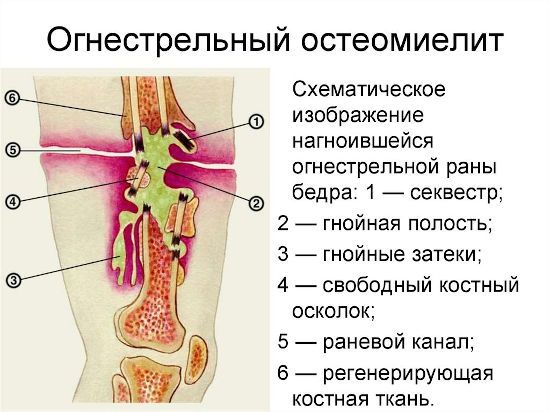 Огнестрельный остеомиелит