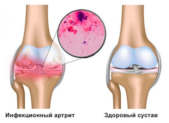 Инфекционный артрит