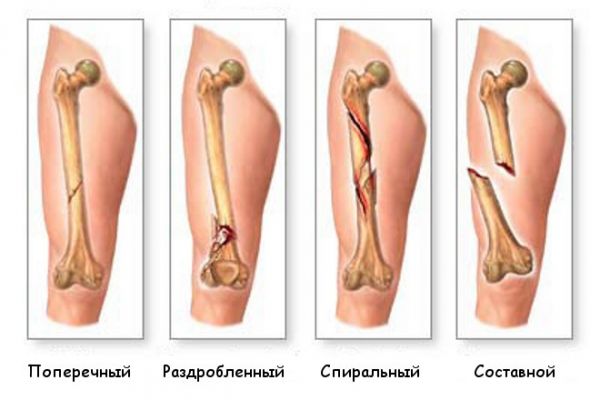 Виды переломов