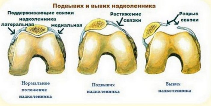 Вывих и подвывих наколенника 