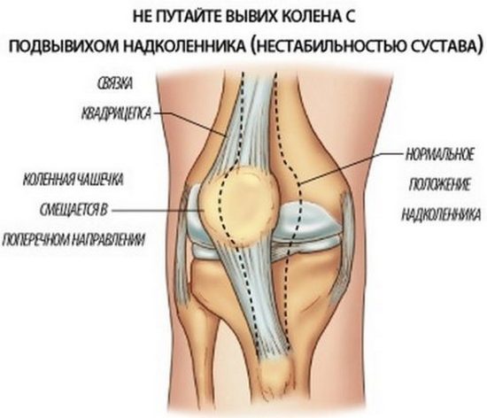 Вывих и подвывих коленной чашечки