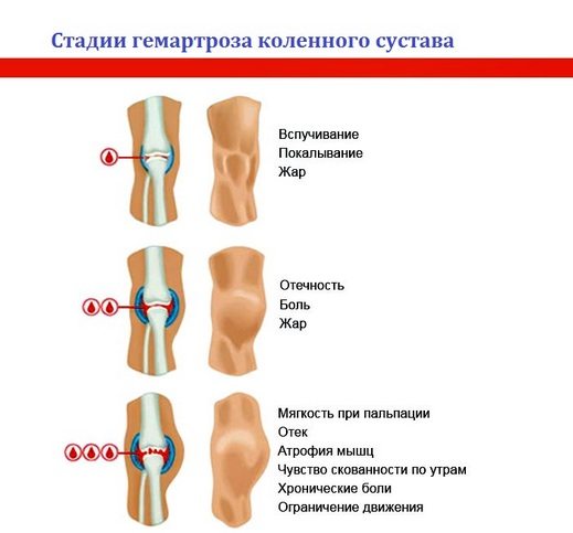 Стадии гемартроза