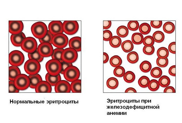 эритроциты при анемии