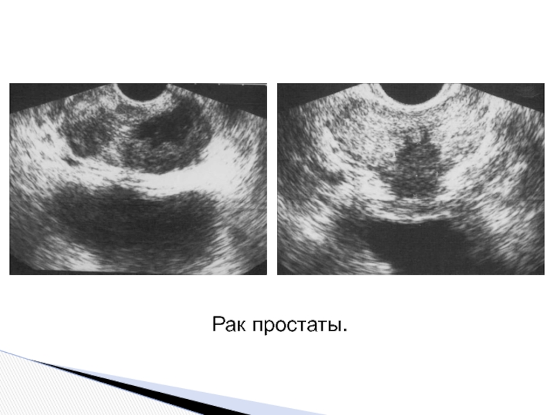 40 гиперплазия предстательной железы. Гиперплазия предстательной железы УЗИ. Аденома предстательной железы на УЗИ. УЗИ трузи предстательной железы.