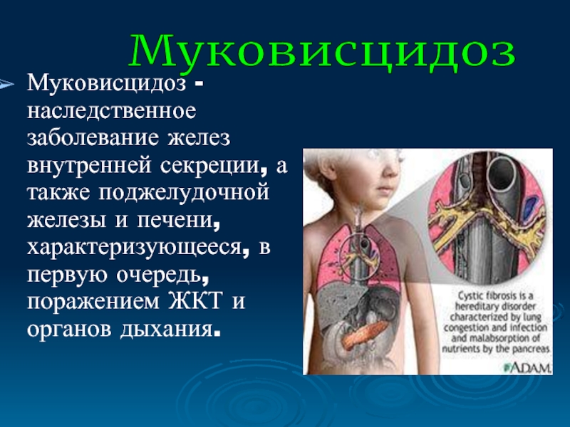 Муковисцидоз что это за болезнь. Генетическое заболевание муковисцидоз.