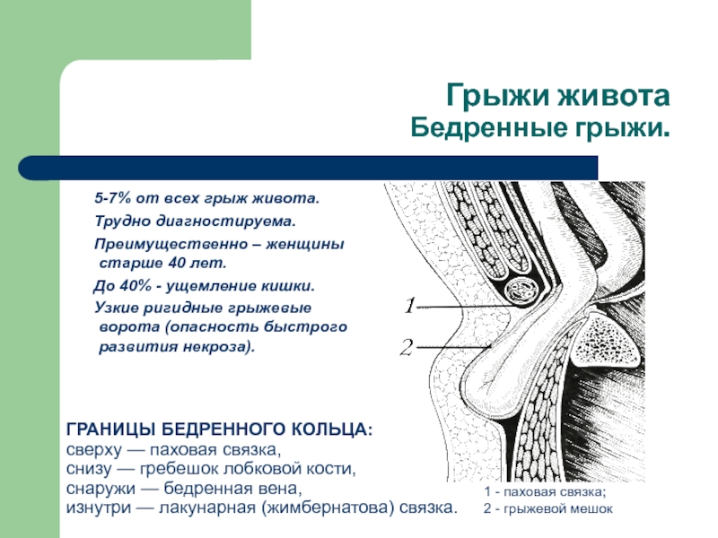 Паховая грыжа у мужчин где находится картинка причины симптомы и причины