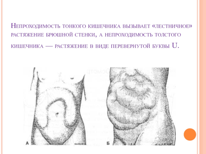 Опущение кишечника. Непроходимость тонкой кишки. При кишечной непроходимости живот. Кишечная непроходимость живот. Живот при непроходимости Толстого кишечника.