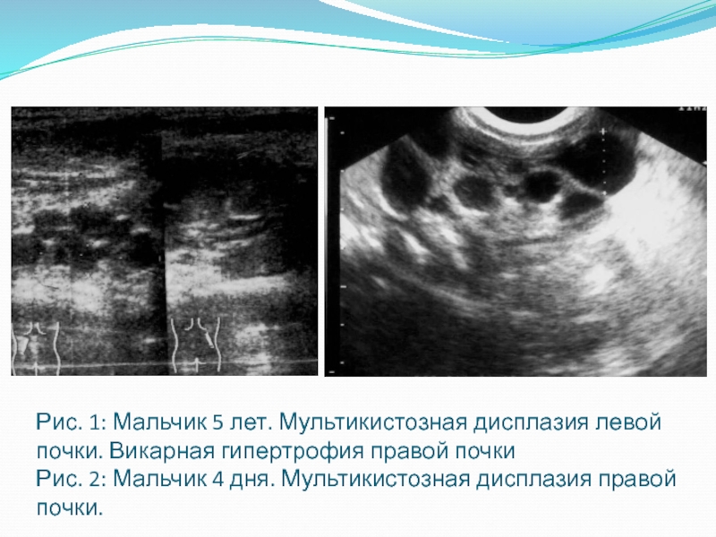 Поликистоз инфильтративного типа мелкокистозного типа дает эхографическую картину