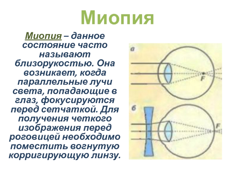 Фокус изображения при миопии