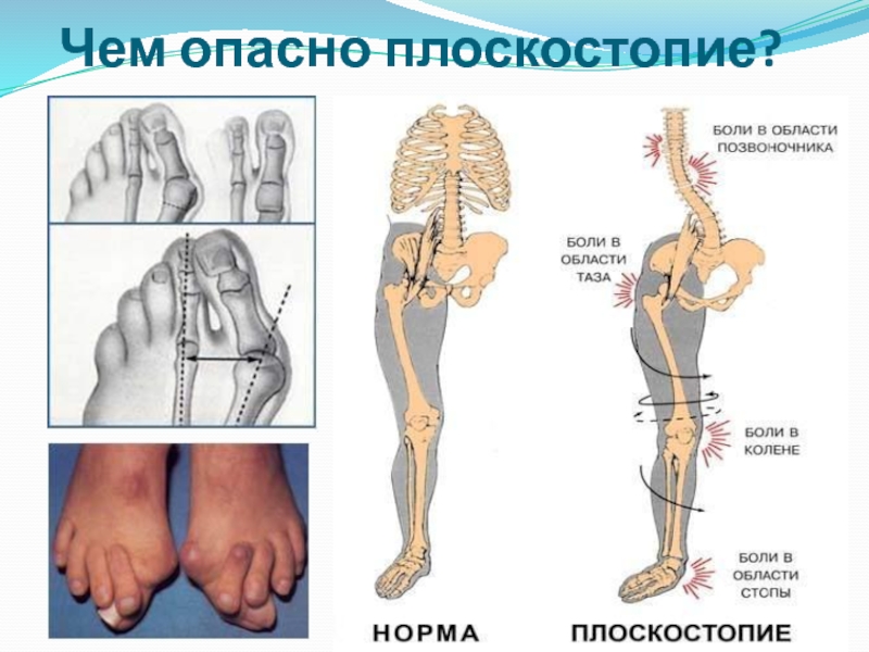 Симптомы поперечного плоскостопия у взрослых фото и лечение признаки