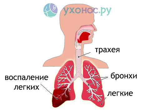 Парагрипп клиническая картина