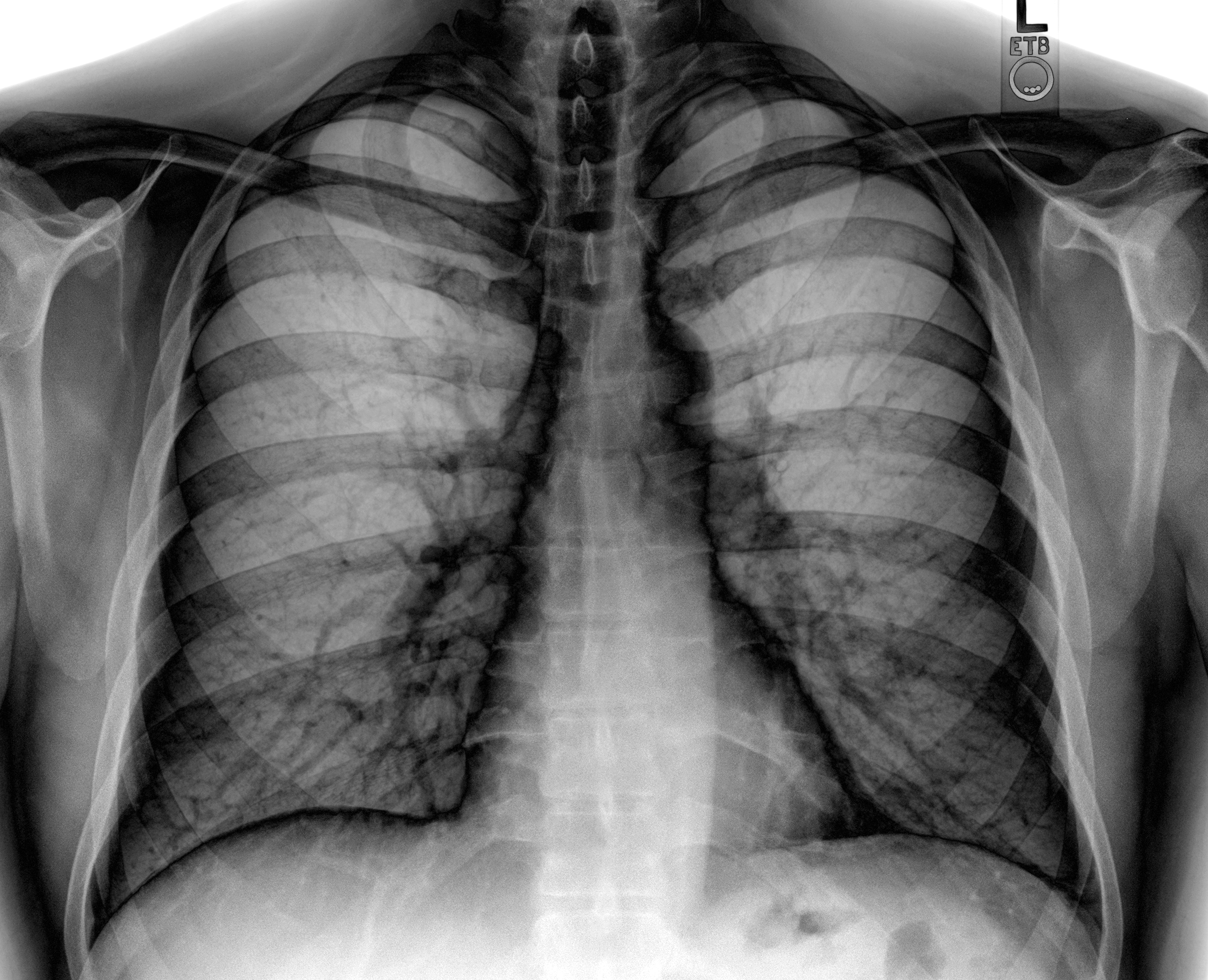 Цифровые рентгенограммы органов грудной клетки