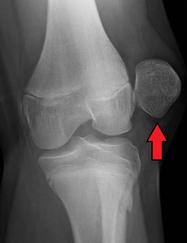 Травма коленного сустава код. Перелом надколенника рентген. Врожденный вывих надколенника рентген. Вывих надколенника рентген. Подвывих коленного сустава рентген.
