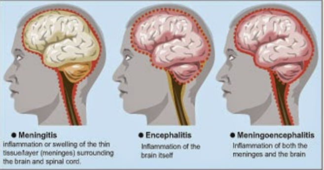 Воспаление головного мозга латынь. Менингит энцефалит и менингоэнцефалит. Менингит и менингоэнцефалит разница. Менингококковая инфекция у детей менингоэнцефалит. Менингоэнцефалит, воспаление головного мозга.