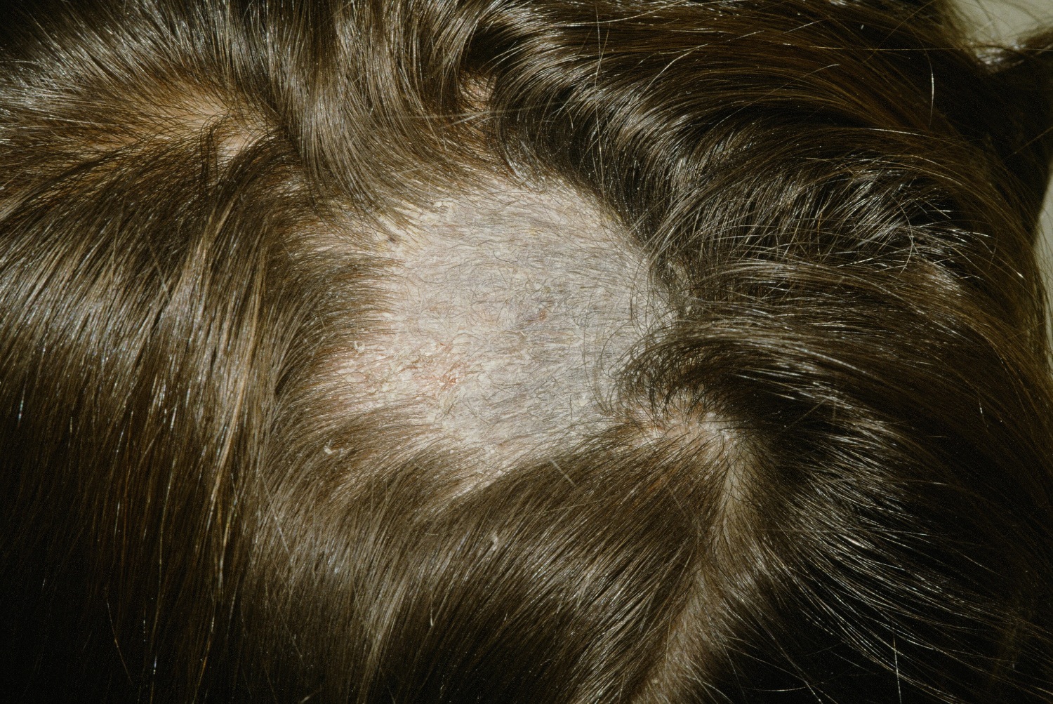 Могут от стрептодермии выпасть волосы если она в волосах