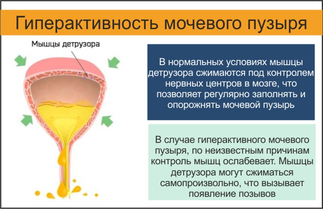 Ощущение мочеиспускания. Гиперактивный мочевой пузырь симптомы. Гиперактивность мочевого пузыря. Гиперактивный мочевой пузырь у женщин. Гипоактивный мочевой пузырь.