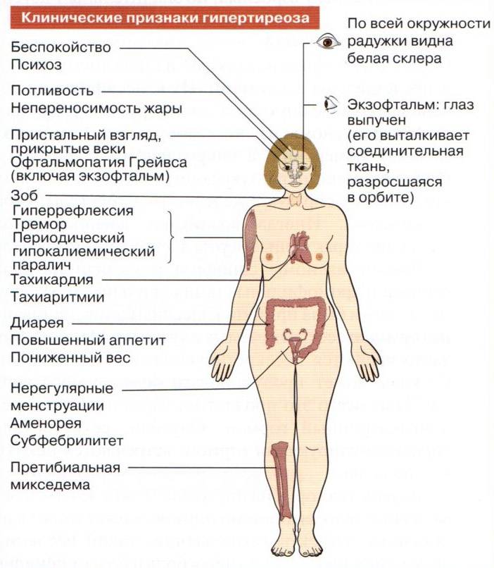Симптомы гипертиреоза у женщин. Заболевания щитовидной железы (гипертиреоз, тиреотоксикоз).. Щитовидная железа симптомы заболевания у женщин гипертиреоз. Симптомы гормоны щитовидной железы гипертиреоз. Гипертиреоз щитовидной железы симптомы.